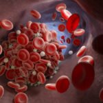 Faire baisser le nombre de plaquettes