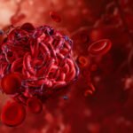 Se débarrasser des caillots sanguins