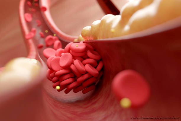 COMMENT SE DÉBARRASSER DES CAILLOTS SANGUINS NATURELLEMENT 3 Causes