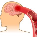 Stimuler l'irrigation sanguine