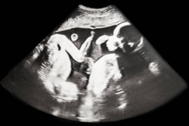 LES MYSTÈRES DES JUMEAUX SÉPARÉS À LA NAISSANCE VIVANT DES VIES PARALLÈLES